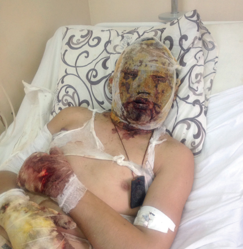 Доржи Батомункуев в госпитале после ранения под Дебальцевым